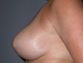 Patient # 87772 After Photo # 6